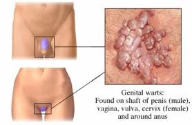 Cervix Cancer Surgery