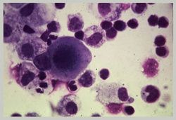 Bone Cancer Surgeons In India