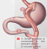 Adjustable Gastric Banding Surgery Offered Along With Special Holiday Package In Goa