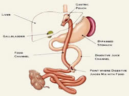How Get Visa Lap Band Surgery India
