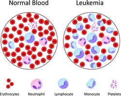 Cml Blood Cancer Treatment In India At An Affordable Price