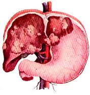 Cost Liver Cancer Surgery In India