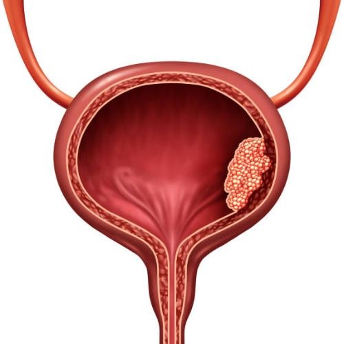 Bladder Cancer Treatment and Surgery in India