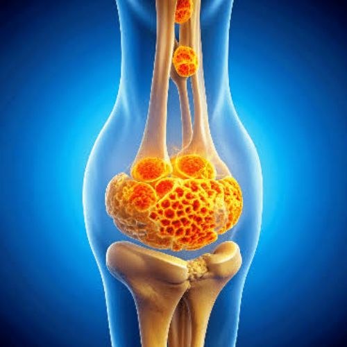 Bone Cancer Treatment and Surgery
