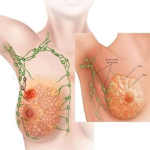 Breast Cancer Treatment And Surgery