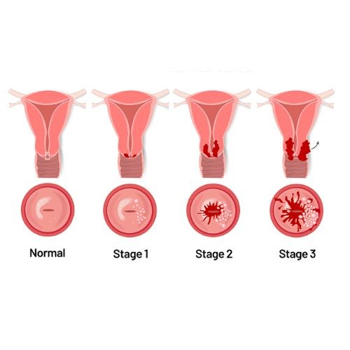 What are various Stages of Cervical Cancer
