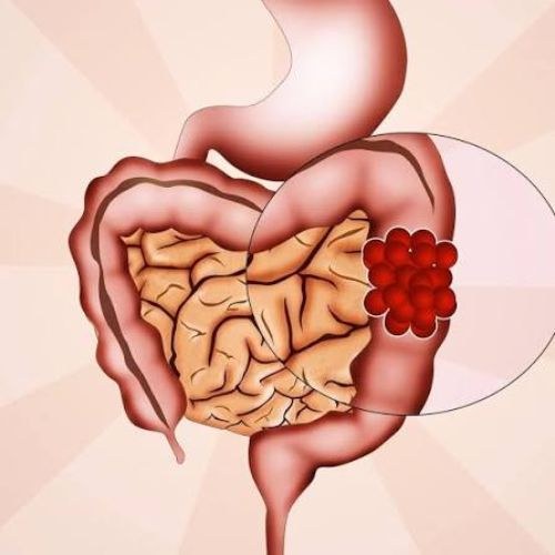 Colon Cancer Surgery In India
