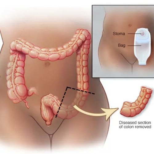 Colon Cancer Treatment And Surgery