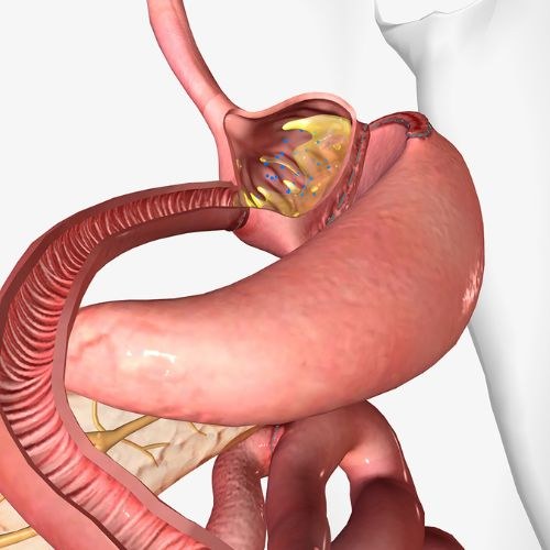 Gastric Bypass Surgery