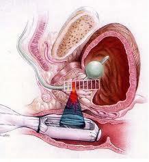 HIFU Prostate Cancer Treatment