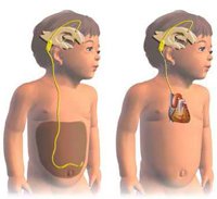Types of Hydrocephalus Surgery