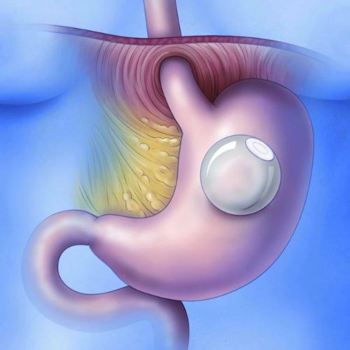 Intragastric Balloon