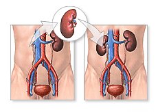 Kidney Transplant In India