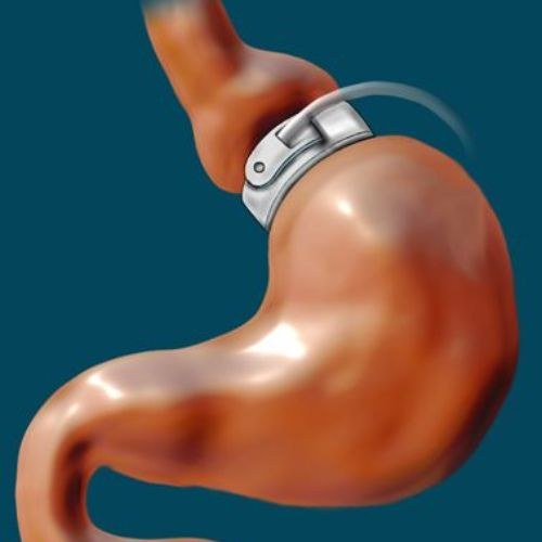 Lap Band Surgery