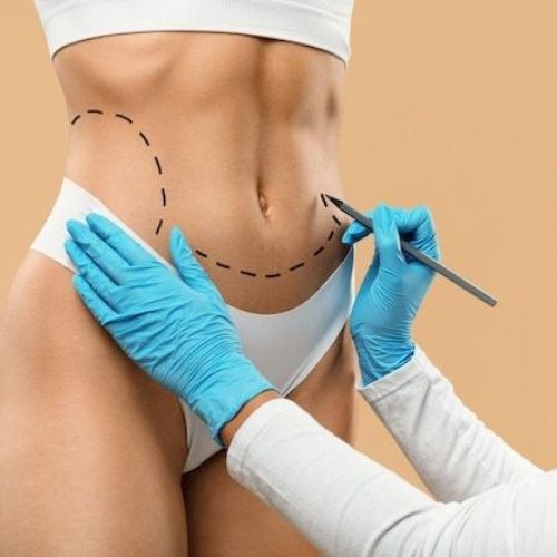 Liposuction Surgery in India
