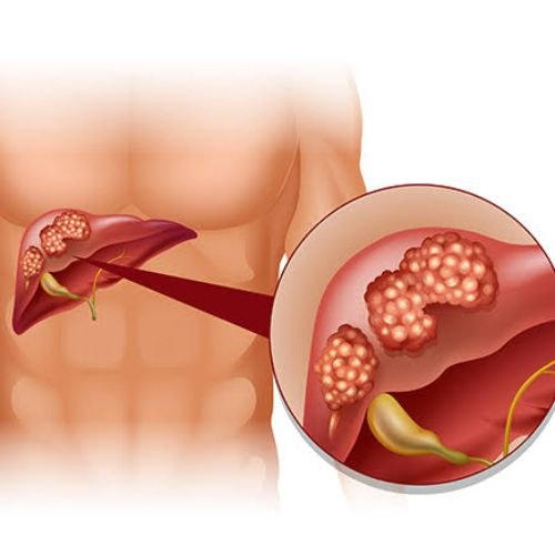 Liver Cancer Treatment And Surgery