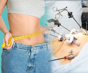Obesity Surgery In India