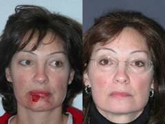 Benefits of Skin Cancer Treatment and Surgery
