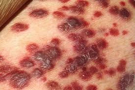 Stages of Skin Cancer