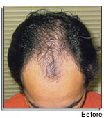 Mr. Nicholas Davis — Toronto Patient Success Story Hair Transplant Surgery India