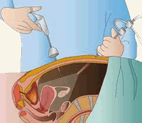 Gynecological conditions or procedures including