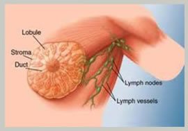 Low Cost Breast Cancer Treatment and Surgery in India