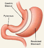 Low Cost Sleeve Gastrectomy Surgery in India