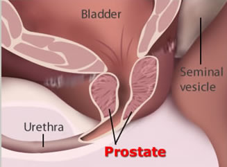 Prostate Cancer Surgery in India