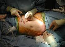 Виды хирургии трансплантации почек