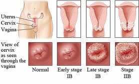 ما هي مراحل مختلفة من سرطان عنق الرحم