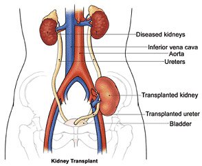 abo incompatible kidney transplant india low cost benefits