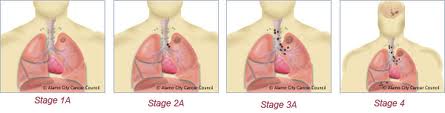 Lung Cancer Treatment and Surgery in India