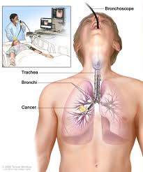 Lung Cancer Treatment and Surgery in India