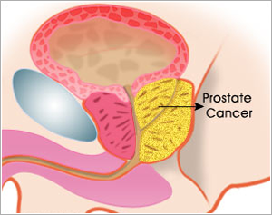 Prostate Cancer Surgery Treatment India Low Cost Benefits