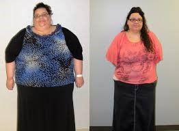 Weight Loss Surgery India Experience
