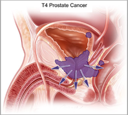 What are the symptoms of Prostate Cancer?